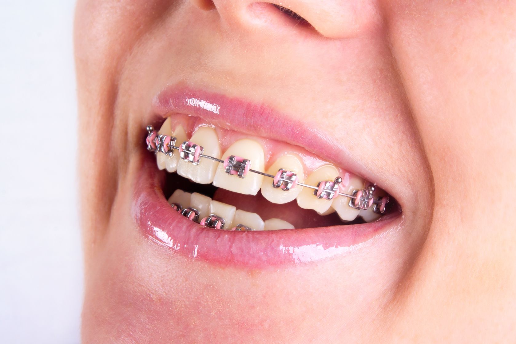 What Parents Should Expect When Their Child Gets Orthodontics Braces In Queens NY