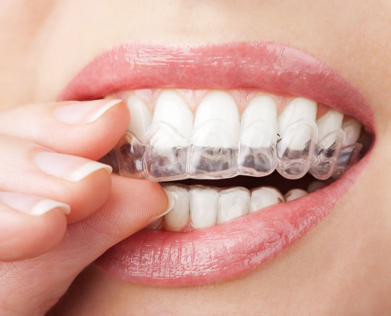 Crooked Teeth? Orthodontists can Straighten Them
