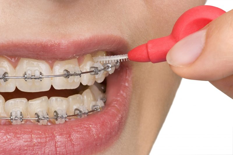 3 Tips to Help Your Wildwood, MO, Teenager Be Excited About Metal Braces