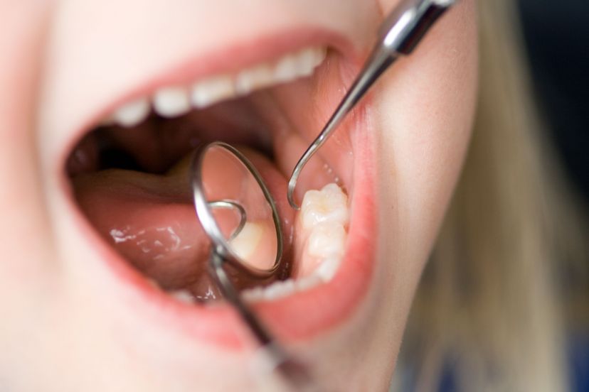 Getting Permanent Dentures in Geneva IL