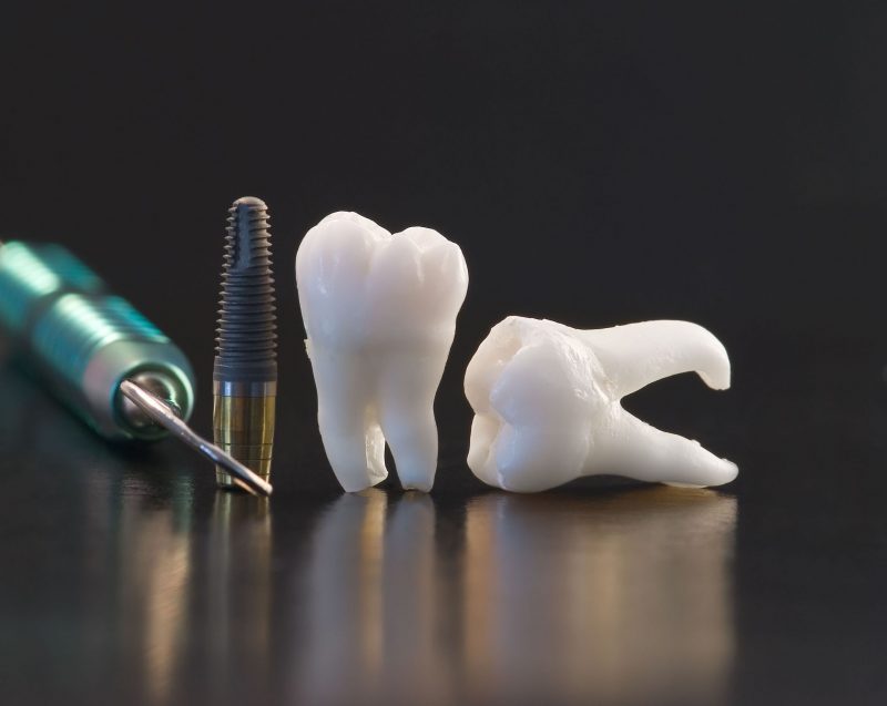 Dental Implants – A Permanent Solution for Missing Teeth