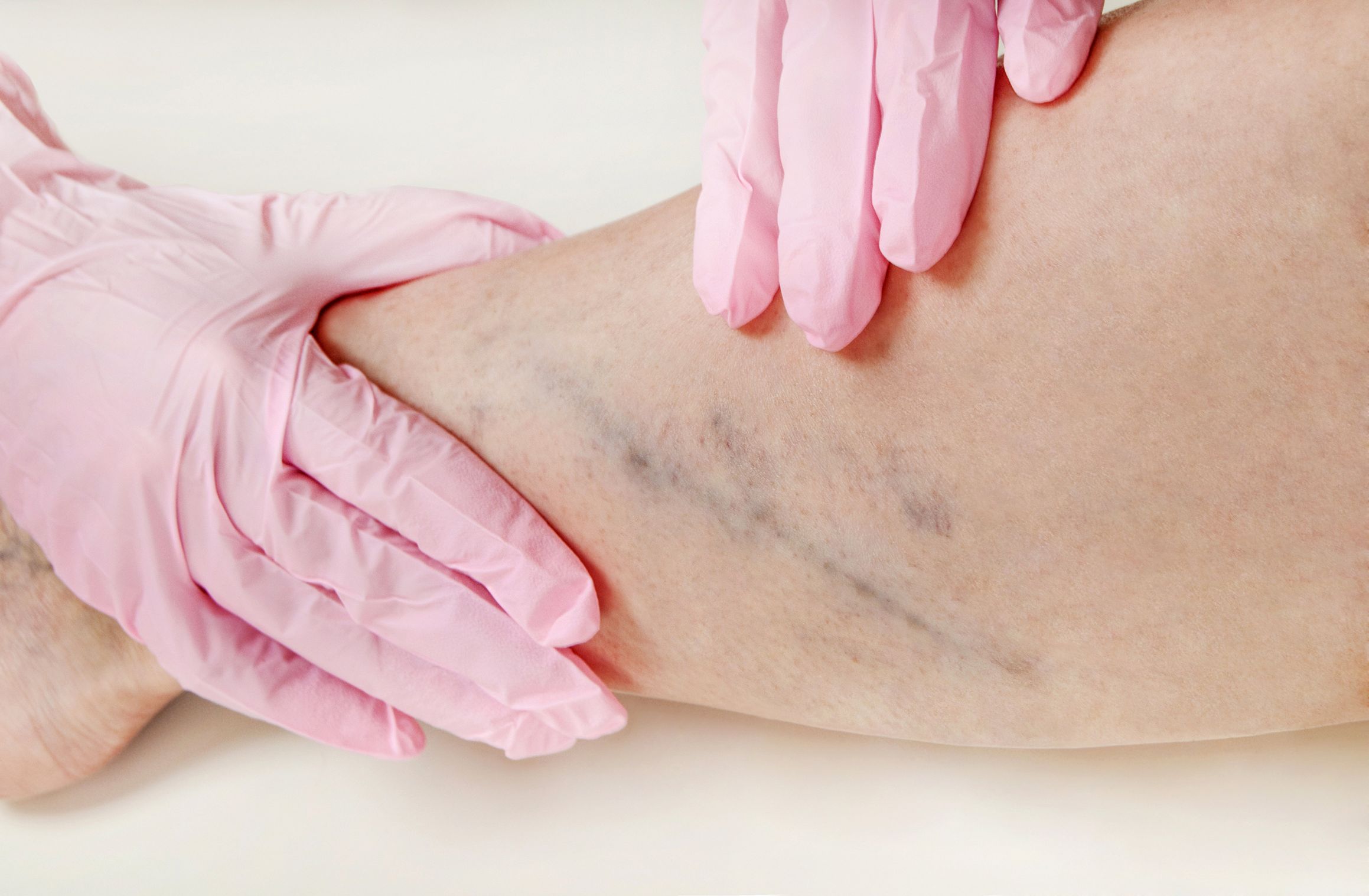 4 Ways Varicose Vein Treatment in New Jersey Improves Mobility
